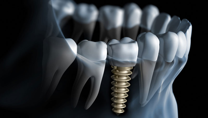 5 MAIORES DÚVIDAS SOBRE OS IMPLANTES DENTÁRIOS